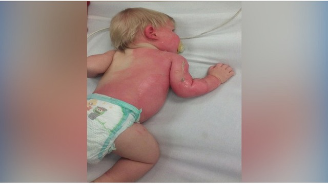 baby scalded